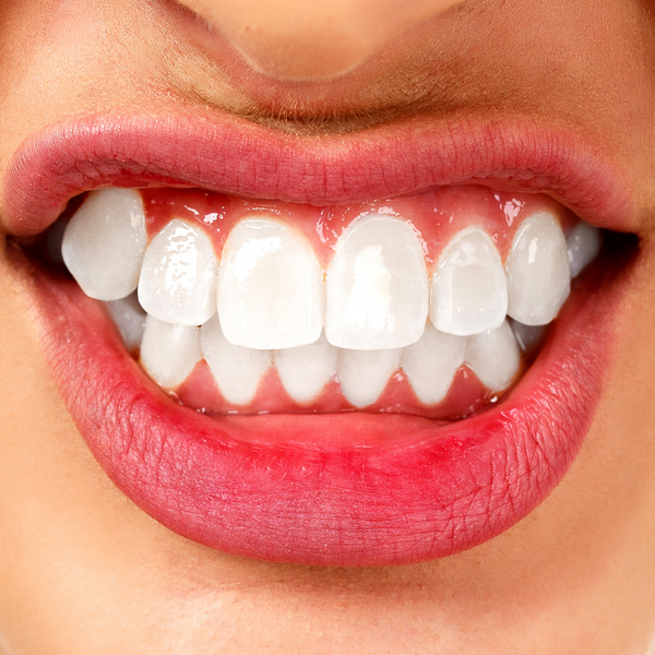 World Oral Health Day 2022: How My Teeth Grinding Caused Sleepless Nights