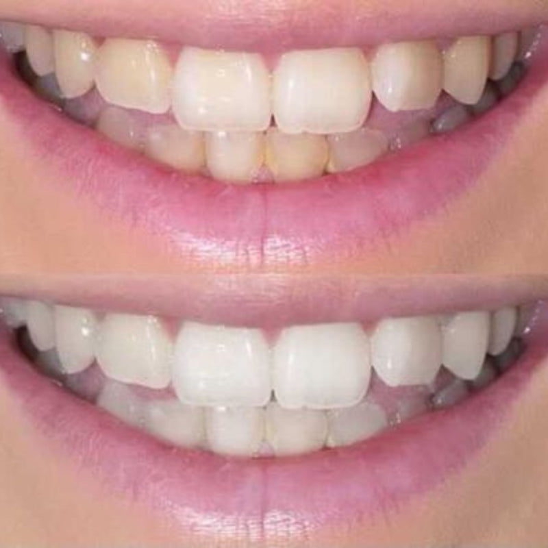 SmileTime Teeth Whitening Results